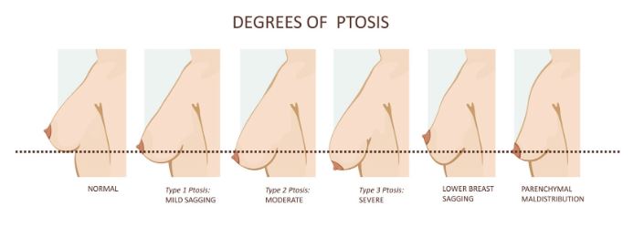 Potřebuji i modelaci prsou