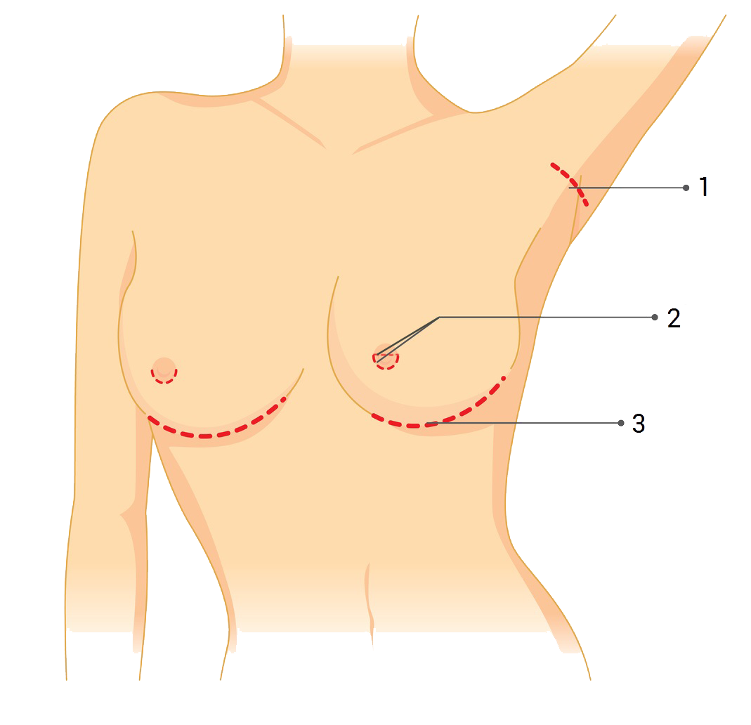 Vložení prsního implantátu