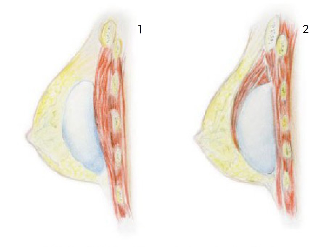 Vložení prsního implantátu